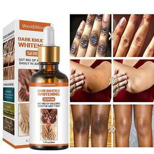 Dark Knuckle Whitening Serum In Blue Earth City in Minnesota +27710732372 Get Rid Of Tattoos In Wick Town in Scotland